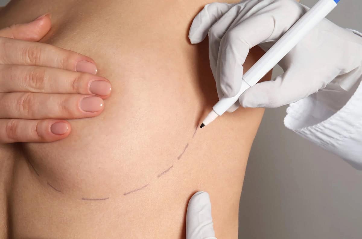 Breast Reduction Surgery Procedure