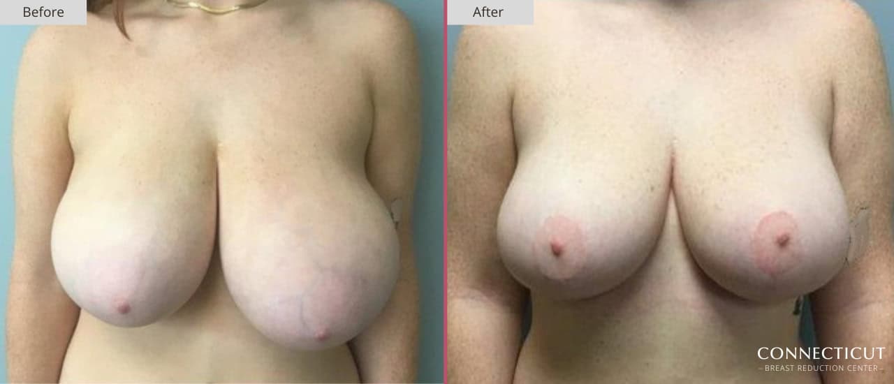 Connecticut Breast Reduction Center Before After 10a