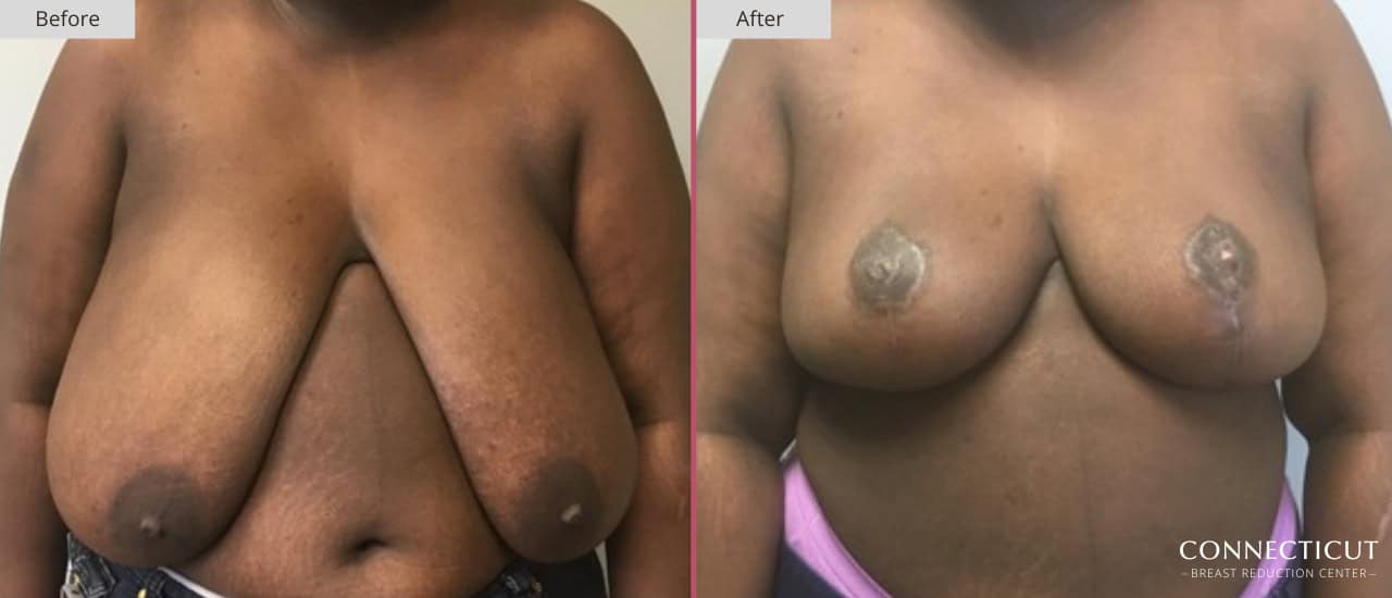 Connecticut Breast Reduction Center Before After 12a