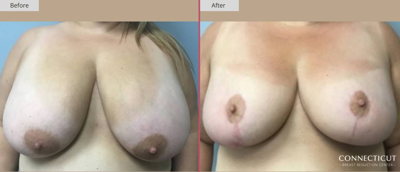 Connecticut Breast Reduction Center Before After 13a