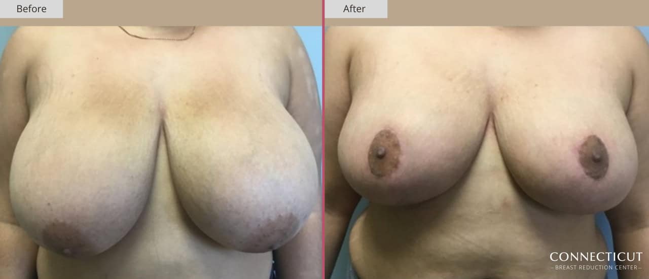 Connecticut Breast Reduction Center Before After 14a