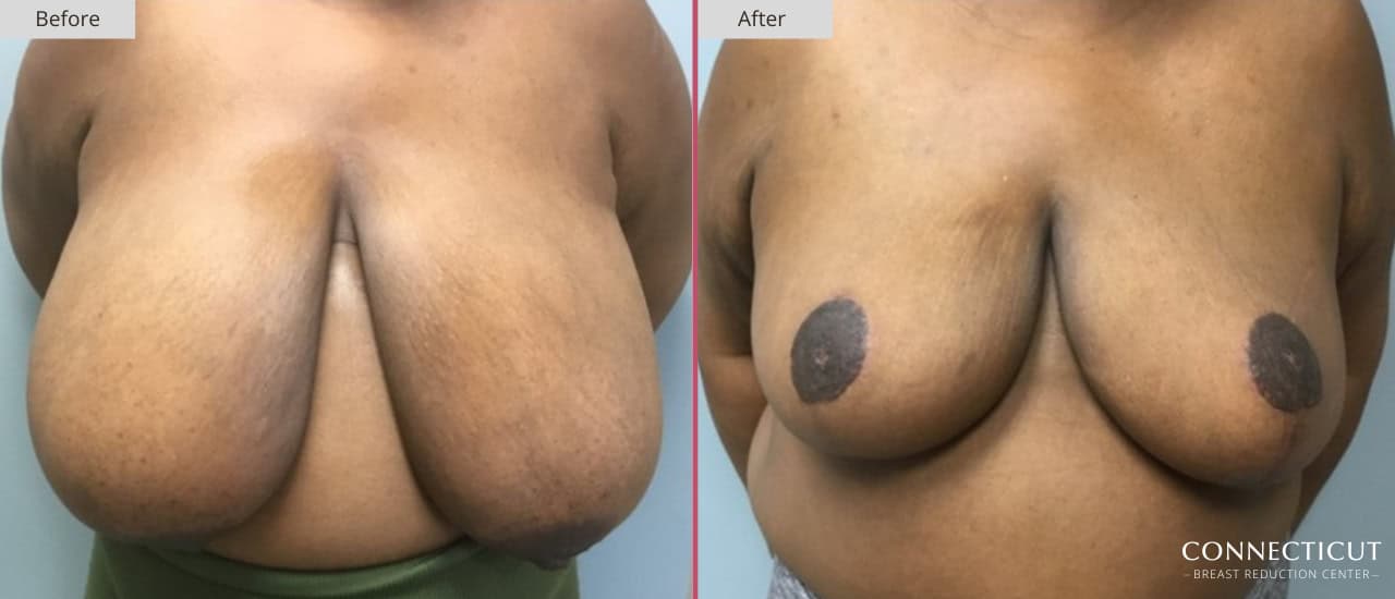 Connecticut Breast Reduction Center Before After 15a