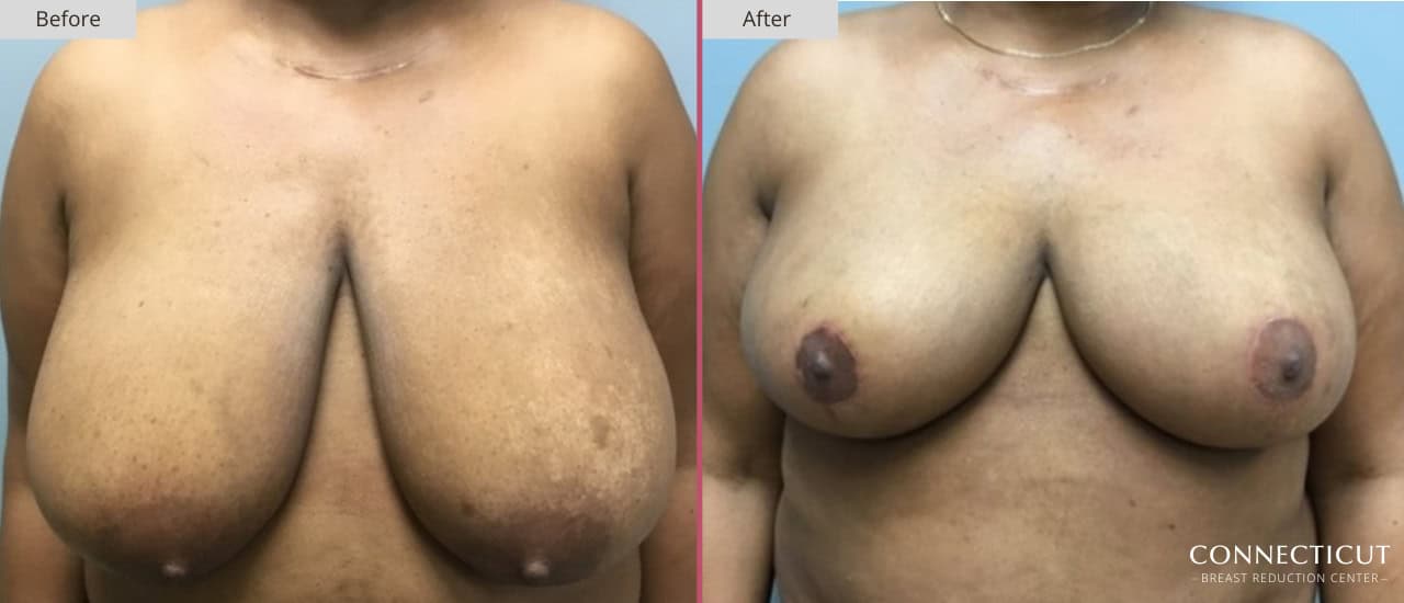 Connecticut Breast Reduction Center Before After 16a
