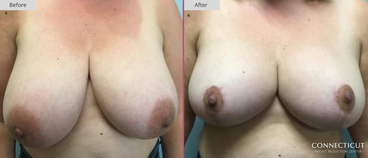 Connecticut Breast Reduction Center Before After 17a