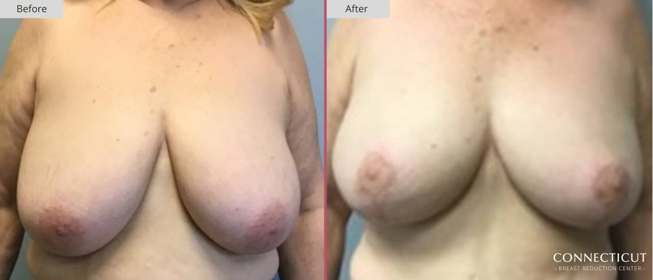 Connecticut Breast Reduction Center Before After 19a