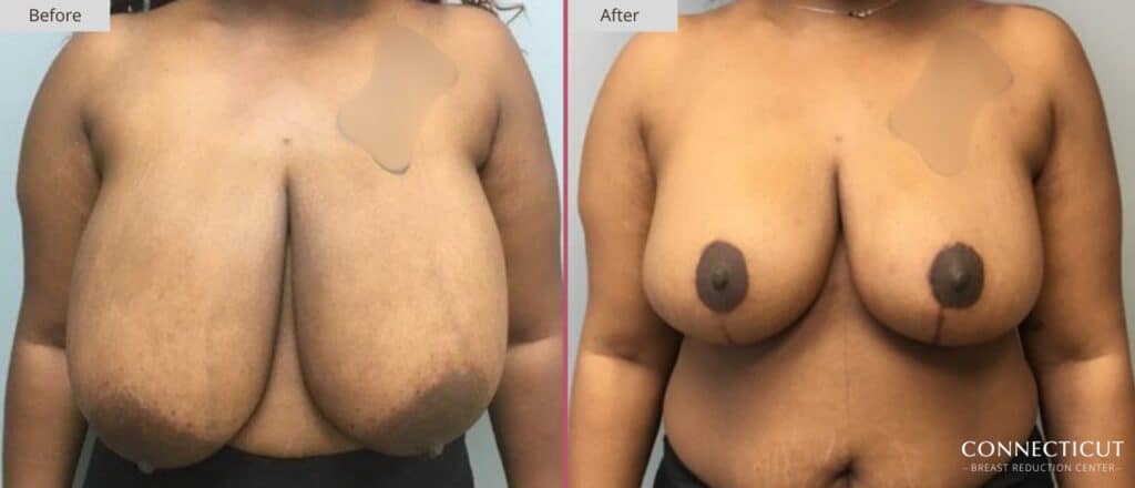 Connecticut Breast Reduction Center Before After 1a
