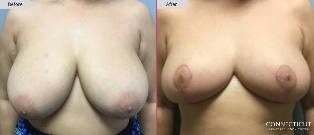 Connecticut Breast Reduction Center Before After 20a