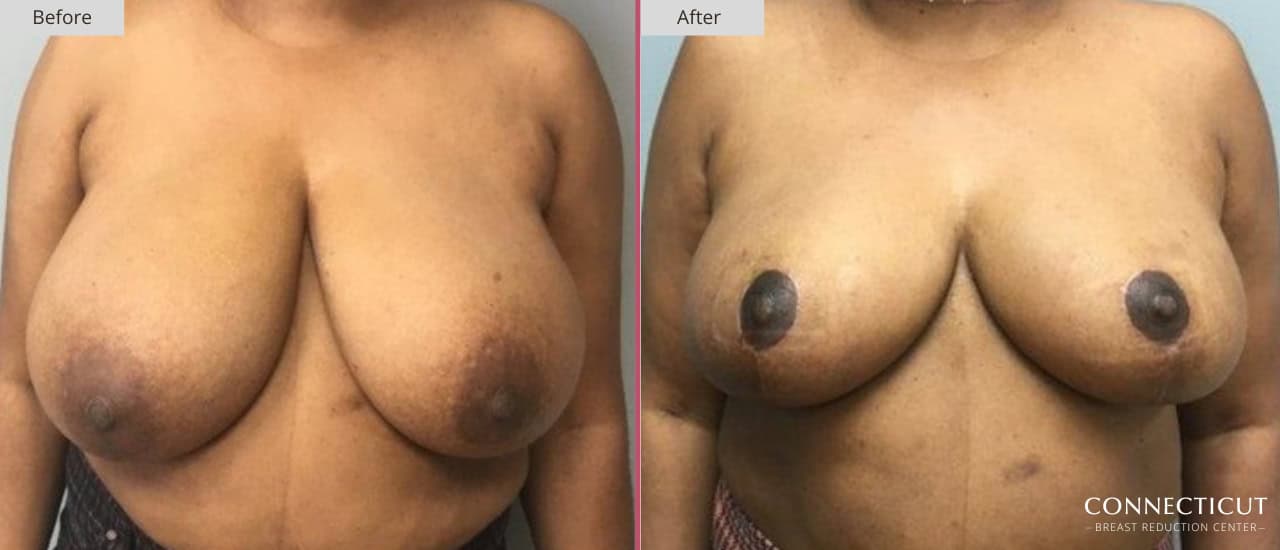 Connecticut Breast Reduction Center Before After 21a