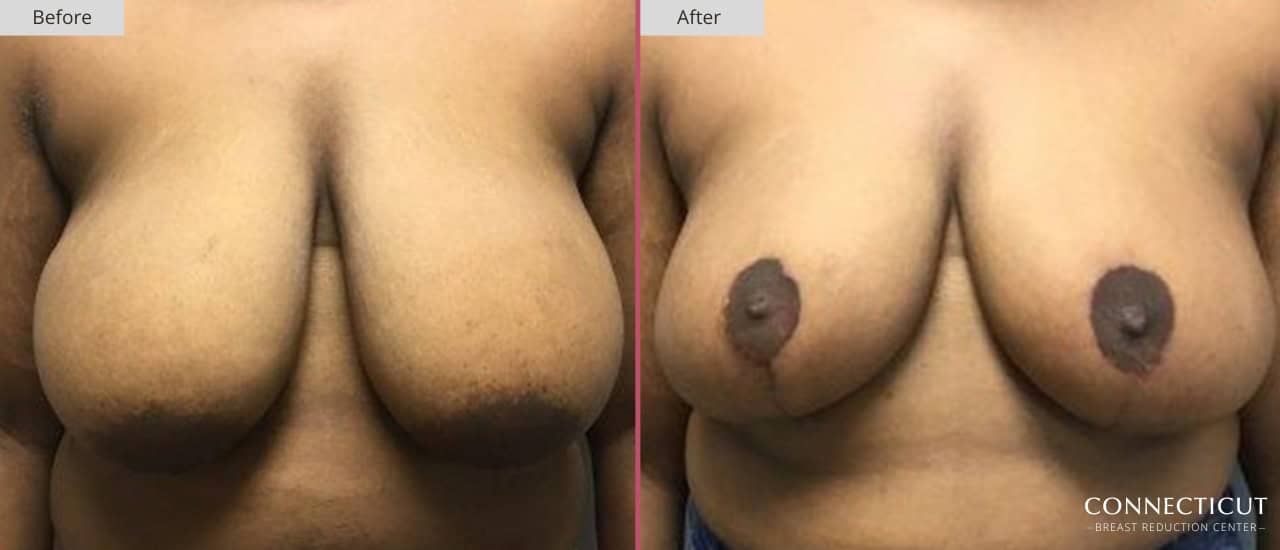Connecticut Breast Reduction Center Before After 22a