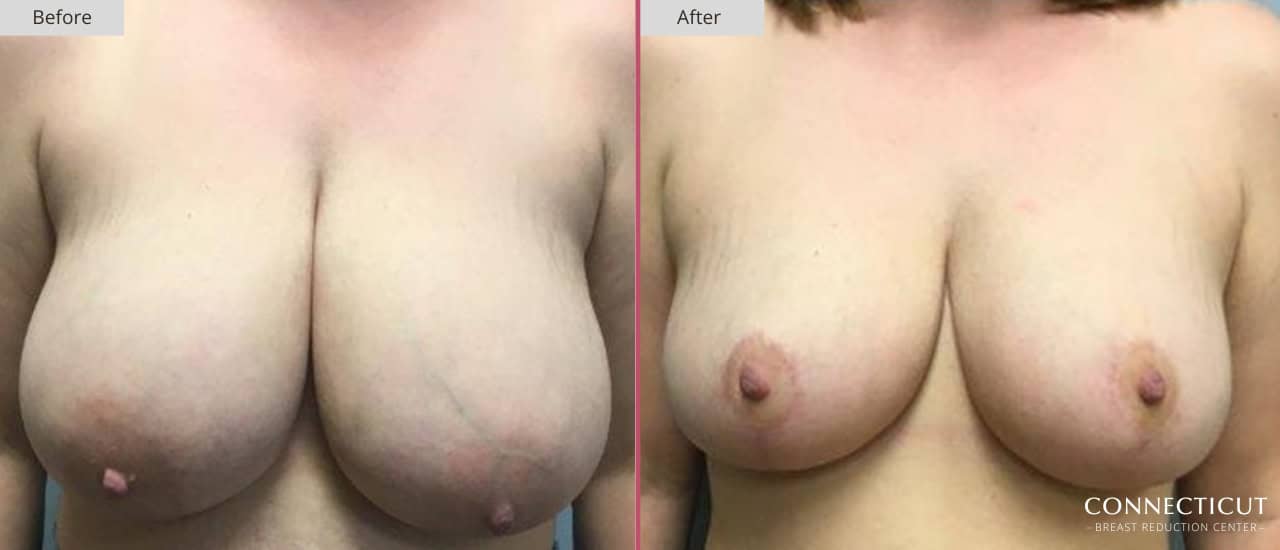Connecticut Breast Reduction Center Before After 23a