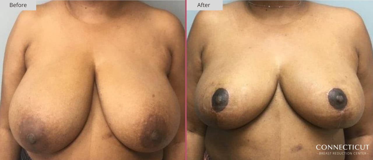 Connecticut Breast Reduction Center Before After 24a