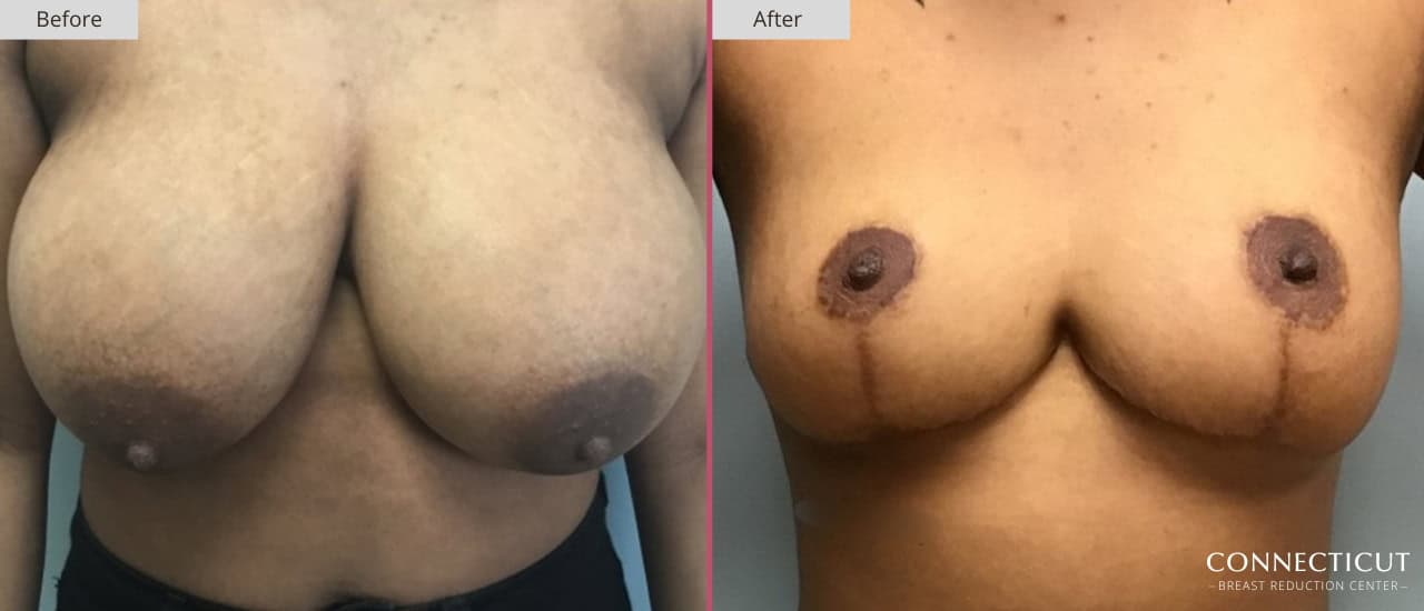 Connecticut Breast Reduction Center Before After 25a