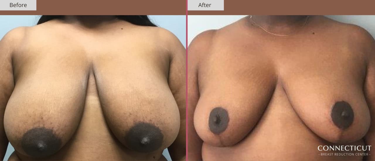 Connecticut Breast Reduction Center Before After 26a