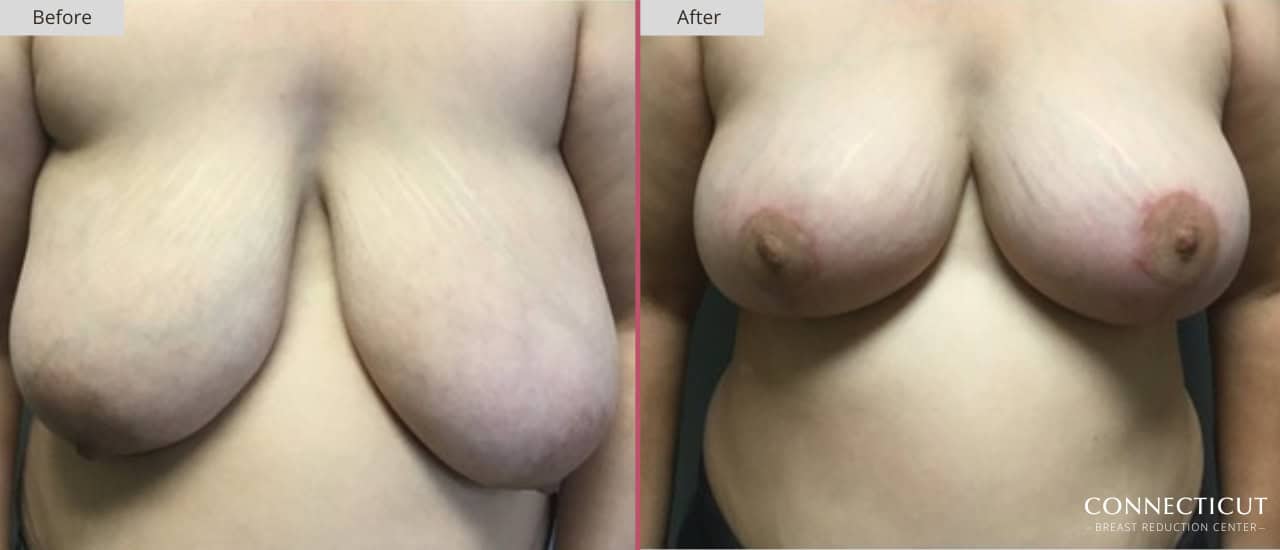 Connecticut Breast Reduction Center Before After 27a