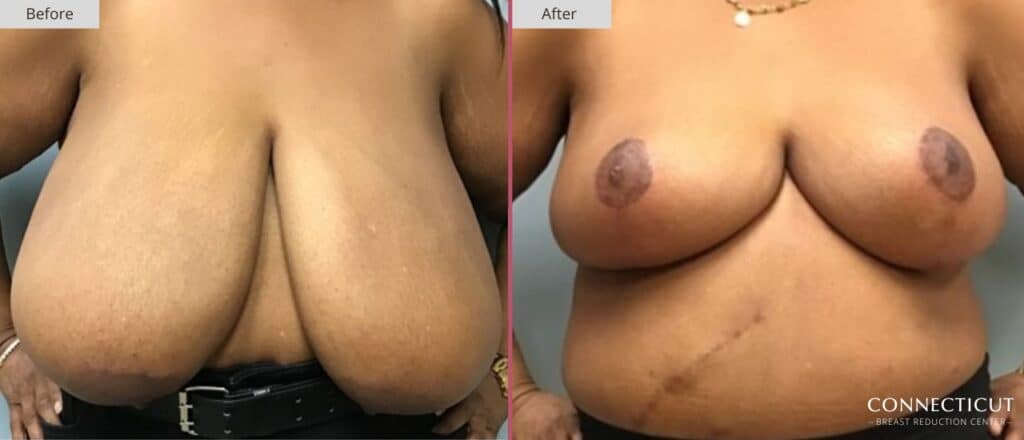 Connecticut Breast Reduction Center Before After 2a