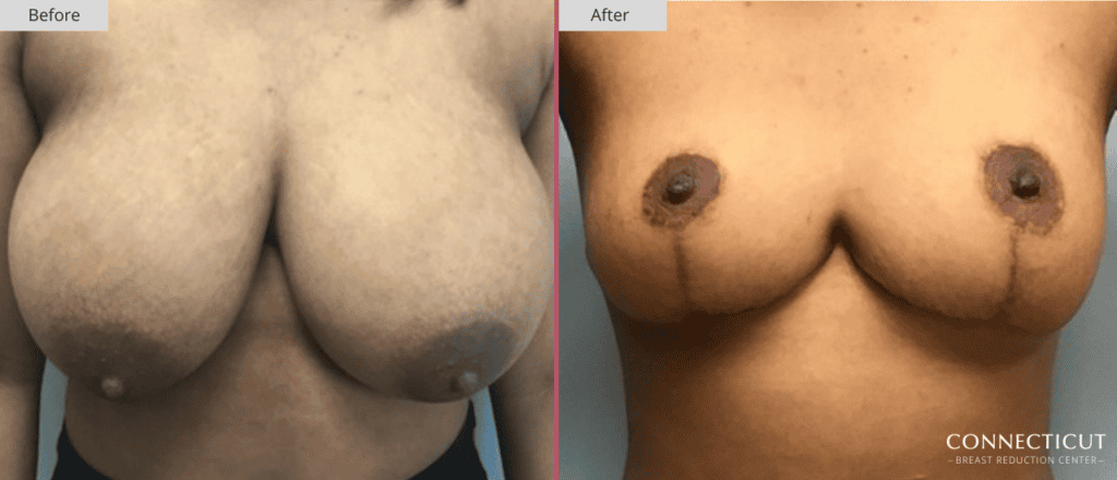 Connecticut Breast Reduction Center Before After 3a