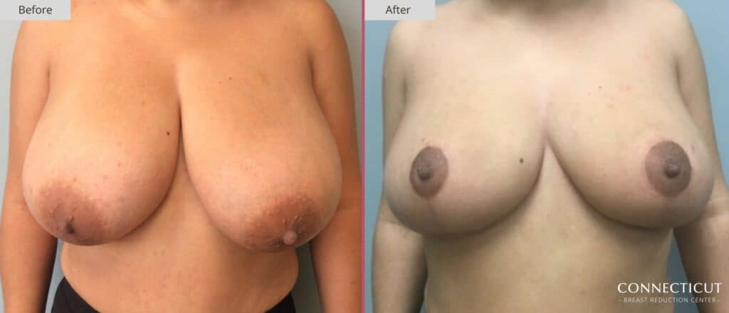 Connecticut Breast Reduction Center Before After 4a