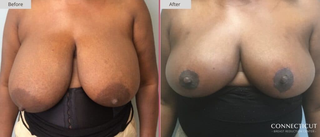 Connecticut Breast Reduction Center Before After 5a