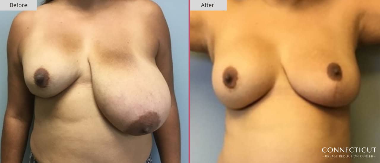 Connecticut Breast Reduction Center Before After 6a