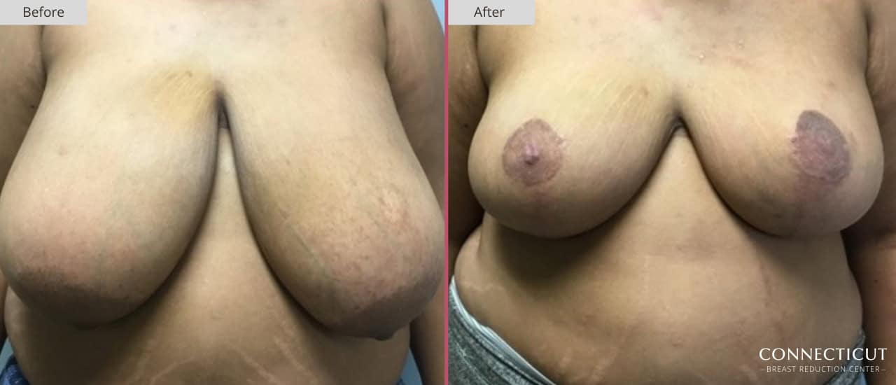 Connecticut Breast Reduction Center Before After 7a