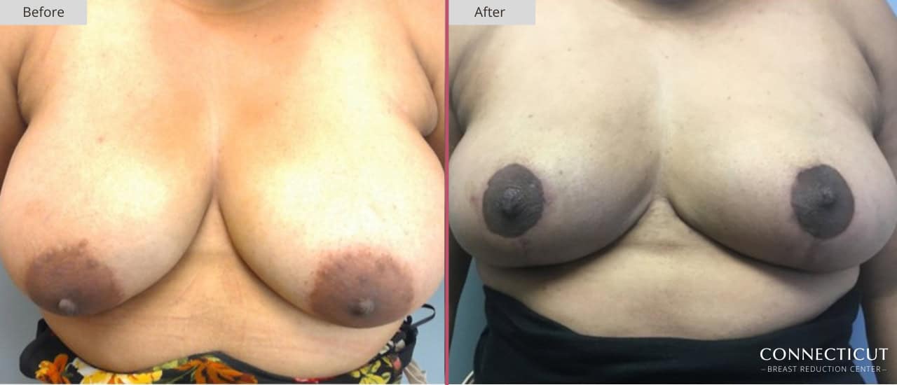 Connecticut Breast Reduction Center Before After 8a
