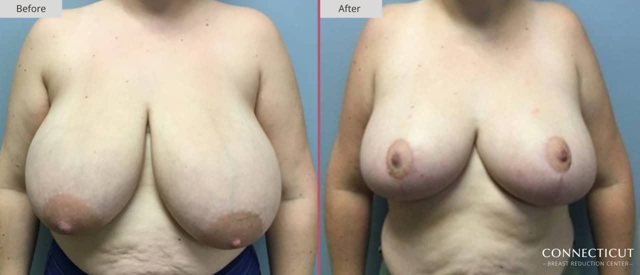 Connecticut Breast Reduction Center Before After 9a