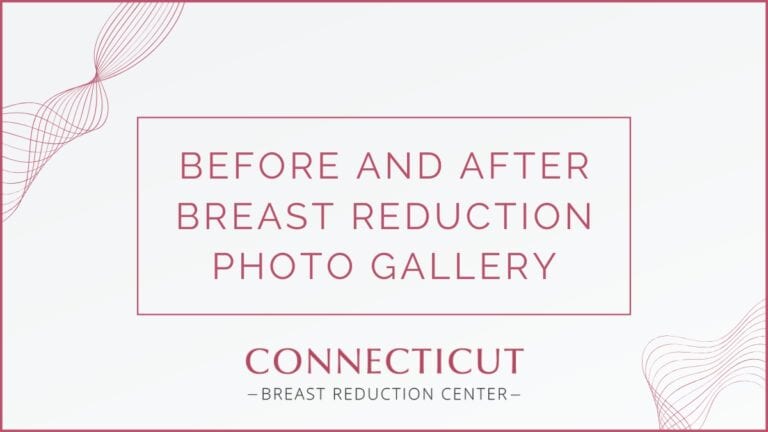Connecticut Breast Reduction Gallery