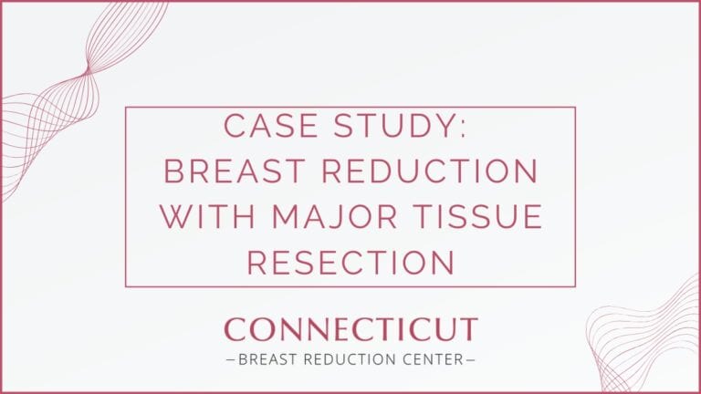 Case Study: Breast Reduction With Major Tissue Resection